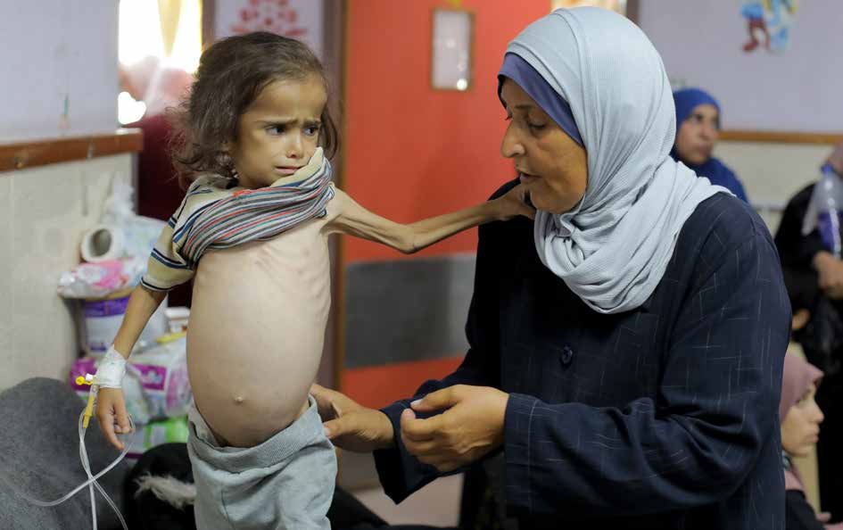 Palestinian children in the Gaza Strip, where the Israeli army has been carrying out attacks for eight months and has restricted humanitarian aid by closing border crossings, are at increased risk of dying from malnutrition and dehydration. Children suffering from malnutrition are receiving treatment under extremely limited conditions at the al-Aqsa Martyrs Hospital in Deir el-Balah.